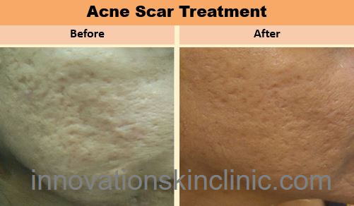 Acne Scars 3